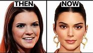 What Happened to Kendall Jenner's Face? | Plastic Surgery Analysis