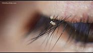 Optometrists are seeing more cases of eyelash lice