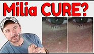 How To Get Rid Of Milia | Hard White Bumps on Face and Eyes | Chris Gibson