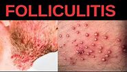 What is Folliculitis? Causes, Symptoms, Treatment