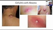 Diagnosis and Treatment of Cellulitis