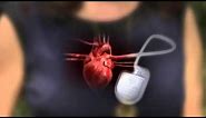 Defibrillator-Pacemaker: What's the Difference?