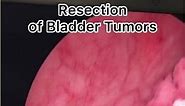 Endoscopic Removal of Bladder Tumor