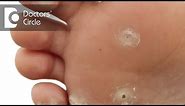 How can we reduce the risk of spreading Plantar Warts? - Dr. Aruna Prasad