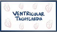 Ventricular tachycardia (VT) - causes, symptoms, diagnosis, treatment & pathology