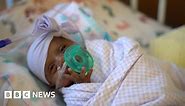 'World's smallest' surviving premature baby released from US hospital