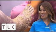 Dr. Lee Treats The Most Severe Skin Condition She’s Ever Seen I Dr. Pimple Popper