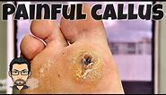 CALLUS REMOVAL FROM FEET