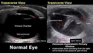 Eye Ultrasound Normal Vs Abnormal Images | Cataract/Retinal Detachment/Globe Rupture/Choroid USG