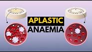 Aplastic Anaemia, Causes, Signs and Symptoms, Diagnosis and Treatment.