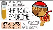 Nephrotic Syndrome Explained Clearly