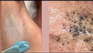 Ingrown hair | Ingrown hair removal | Pimple popping