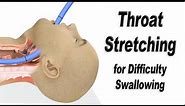 Esophageal Dilation or Throat Stretching for Difficulty Swallowing