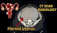 Uterine Fibroid | Diagnosis | Ct scan | Radiology |