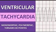 Ventricular Tachycardia (V-tach) ECG Interpretation, Treatment, Nursing NCLEX Review