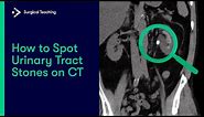 Urinary Tract Stones | How do we Diagnose them on CT Scans?