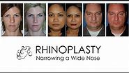 Rhinoplasty - How can a wide nose be narrowed