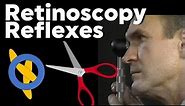 Scissor Reflex + Retinoscopy Problems: Keratoconus Spherical Aberration Plus Cylinder Retinoscopy