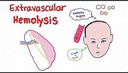 Extravascular Hemolysis