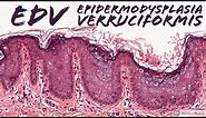 Epidermodysplasia Verruciformis (EDV): 5-Minute Pathology Pearls