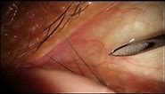 Cyst Incision & Drainage on Bulbar Conjunctiva Eye