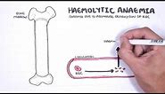 Haemolytic Anaemia - classification (intravascular, extravascular), pathophysiology, investigations