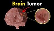Brain tumors (Gliomas) | Symptoms, Diagnosis & Treatments