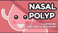 What is Nasal Polyp?