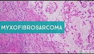 Myxofibrosarcoma 101...Explained by a Sarcoma Pathologist