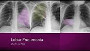 Lobar Pneumonia: Chest X-ray Atlas