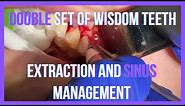 Unusual Case: Extra Wisdom Teeth in Upper Jaw - Surgical Removal and Oroantral Communication Closure
