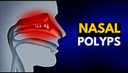 NASAL POLYPS, Causes, SIgns and Symptoms, Diagnosis and Treatment.