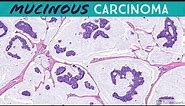 Primary Cutaneous Mucinous Carcinoma & Endocrine Mucin-Producing Sweat Gland Carcinoma