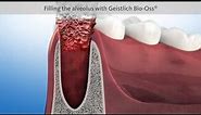 Socket and ridge preservation (Dental Animation)