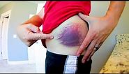 HOW DID THIS HAPPEN!? Massive Gross Bruise!