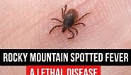 Rocky Mountain Spotted Fever (RMSF)