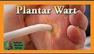 Plantar Wart Treatment | Auburn Medical Group
