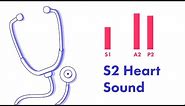 Split S2 Heart Sound - Learn How to Auscultate