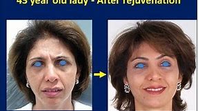 How 43 Year Old Women Made Her Look Younger without Surgery | | Liquid Facelift Non-Surgical