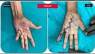 Dupuytren’s contracture surgery