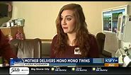Mother's pregnancy journey with Mono Mono twins - Medical Minute