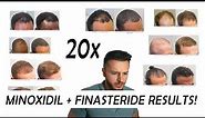 20 Finasteride and Minoxidil before and after Results!!! NW2 - NW5/6