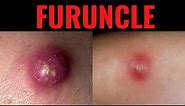 What is Furuncle? Furuncle (Boil) Definition,Causes, Symptoms, Risk Factors, USMLE