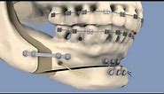 BSSO & Osseous Genioplasty