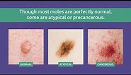 Atypical Moles vs. Precancerous Moles vs. Normal Moles | SERO