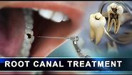 Root Canal Treatment step by step | Curveia Dental Animation in 3D - Endodontics for tooth decay
