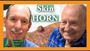 Skin HORN removal | Auburn Medical Group