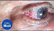 GRAPHIC: Moment 15cm long worm is removed from mans eye