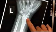 Wrist X-ray in a child