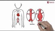 What is an Abdominal Aortic Aneurysm?